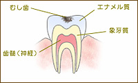 C1：エナメル質の虫歯