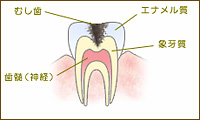 C2：象牙質の虫歯