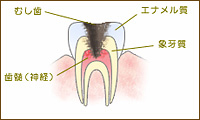 C3：神経まで進行した虫歯