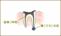 C4：歯根まで進行した虫歯